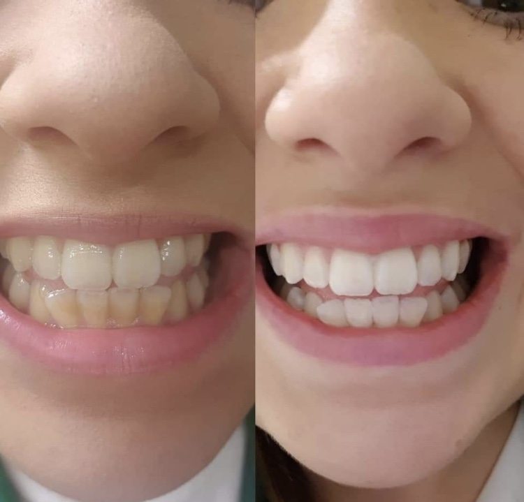 Teeth Whitening Bournemouth & Ringwood, Cosmetic Tooth Whitening Dorset