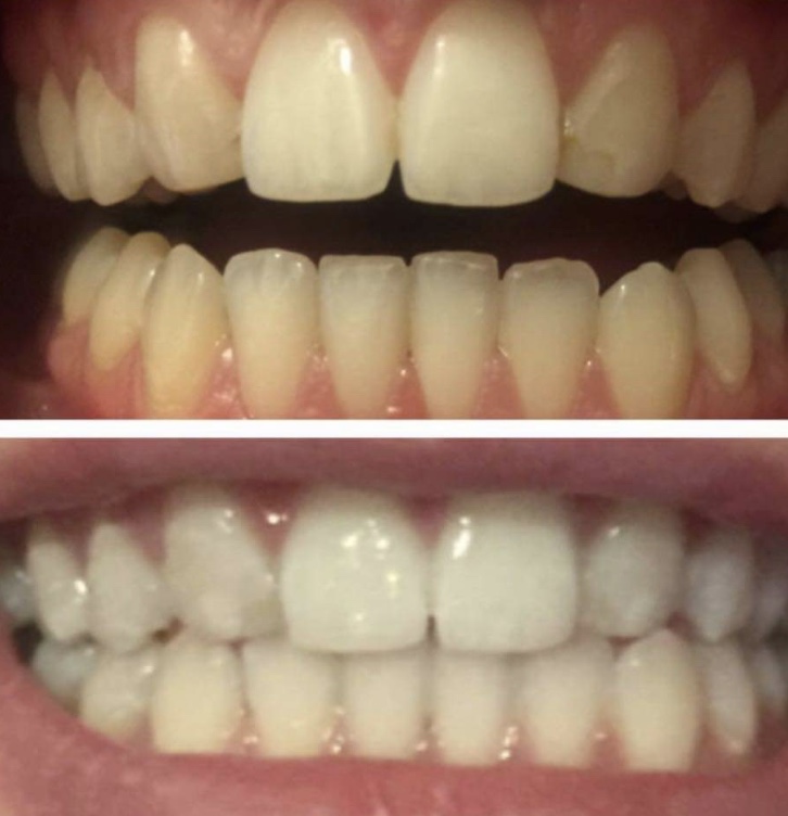 before and after laser teeth whitening