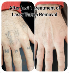 Laser Tattoo Removal in Bournemouth, Poole, Dorset, Ringwood & surrounding areas