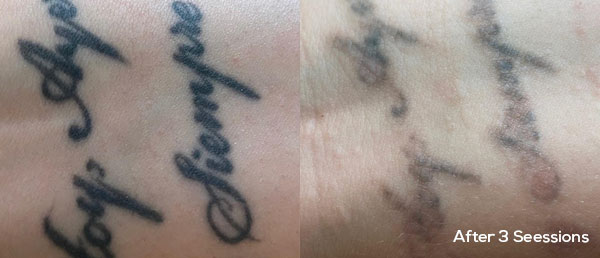 Laser Tattoo Removal Bournemouth, Poole, Ringwood - Resolve Clinics