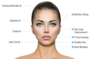 HIFU Facial Treatment Areas